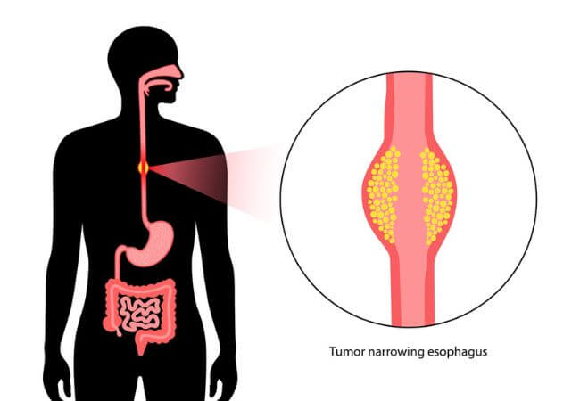 Esophageal Cancer Qmch Dp