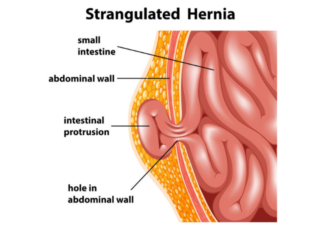 Hernia Cnv 2