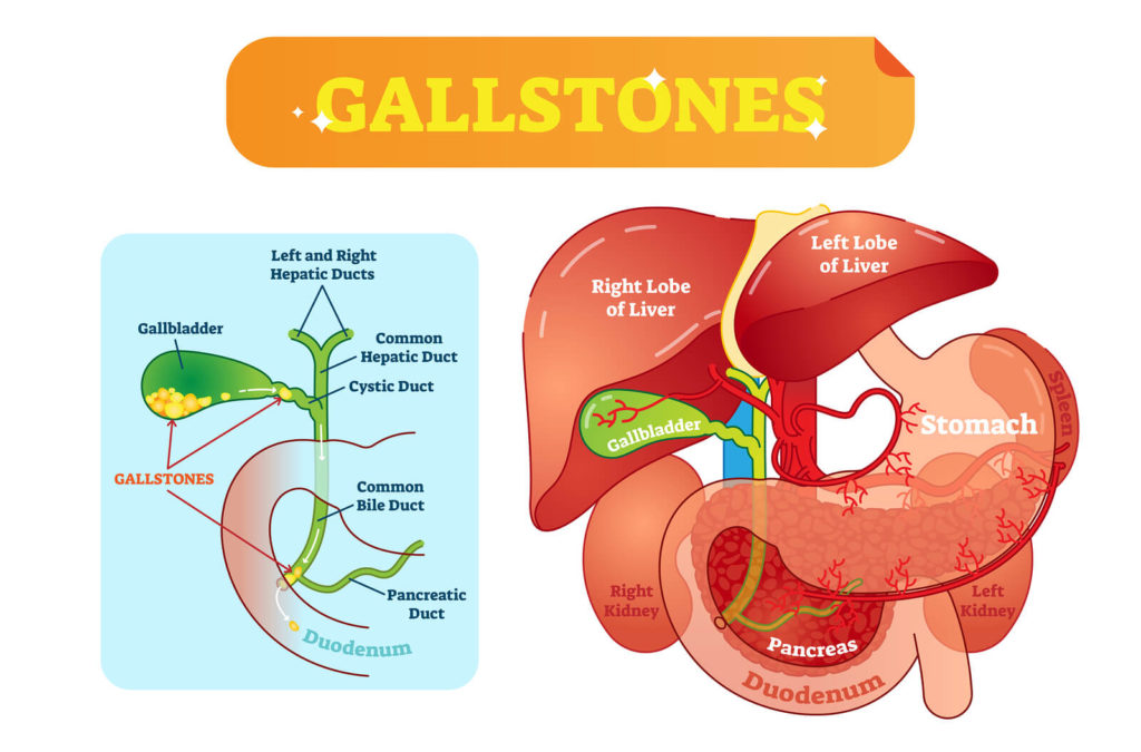 Bigstock Gallstones